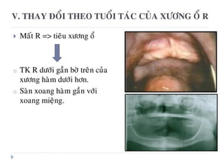 xương ổ răng.pdf