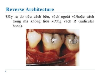 xương ổ răng.pdf