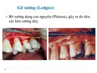 xương ổ răng.pdf