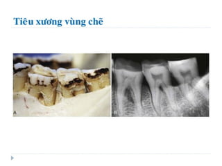 xương ổ răng.pdf