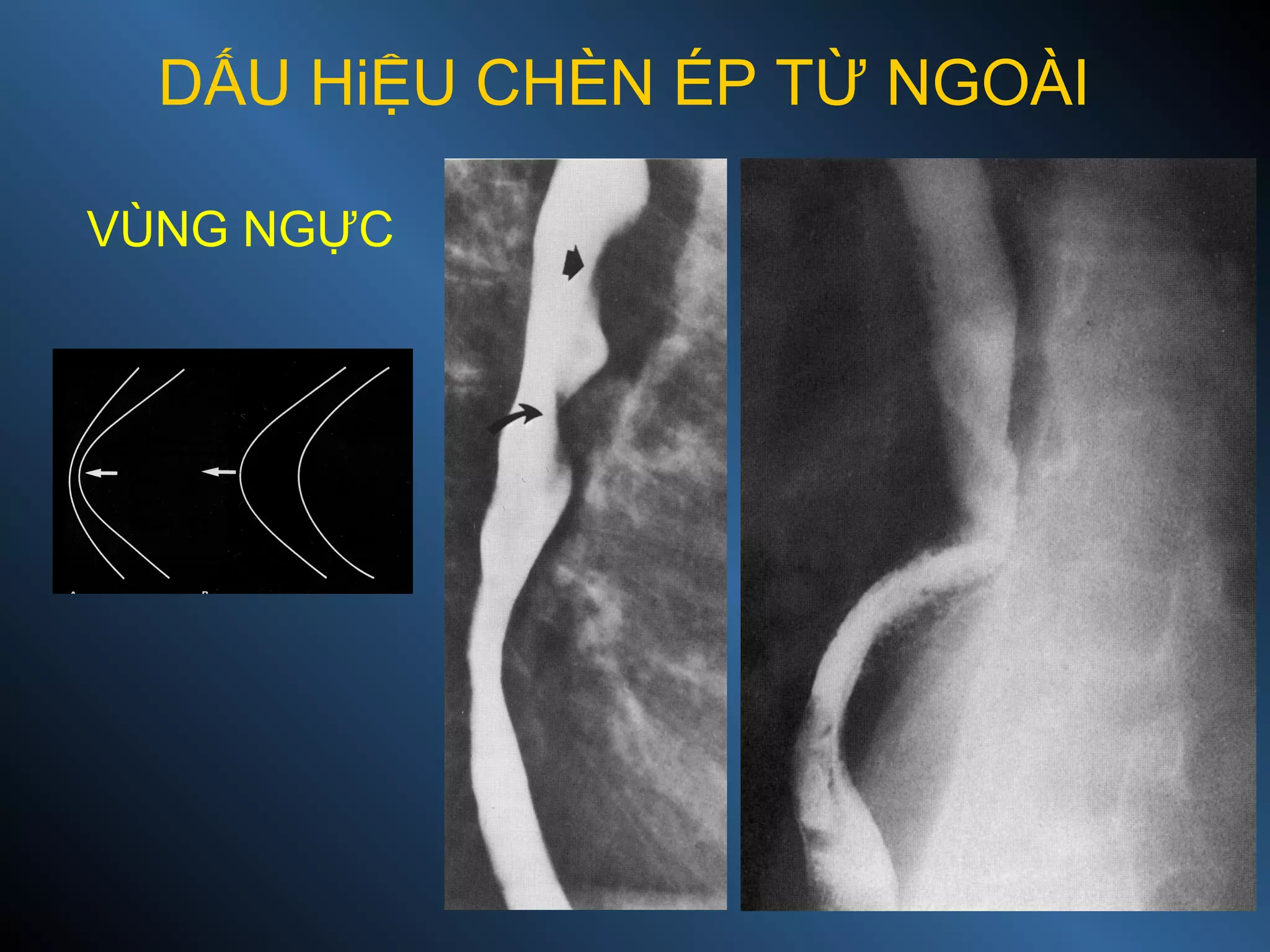DẤU HiỆU CHÈN ÉP TỪ NGOÀI
VÙNG NGỰC
 