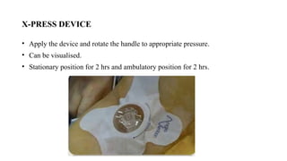X-PRESS DEVICE
• Apply the device and rotate the handle to appropriate pressure.
• Can be visualised.
• Stationary position for 2 hrs and ambulatory position for 2 hrs.
 