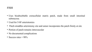 FISH
• Uses bioabsorbable extracellular matrix patch, made from small intestinal
submucosa.
• Used for 5-8F arteriotomies
• Patch straddles arteriotomy site and suture incorporates the patch firmly at site
• Portion of patch remains intravascular
• No documented complications
• Success rates = 98%
 