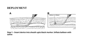 DEPLOYMENT
Step 1 – Insert device into sheath upto black marker. Inflate balloon with
saline
 