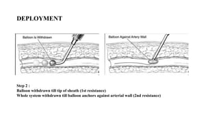 DEPLOYMENT
Step 2 :
Balloon withdrawn till tip of sheath (1st resistance)
Whole system withdrawn till balloon anchors against arterial wall (2nd resistance)
 