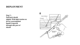 DEPLOYMENT
Step 3 :
Pull back sheath
slightly With light tension on
device, procoagulant
liquid is injected
through side port of
sheath
 