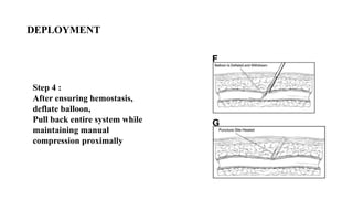 DEPLOYMENT
Step 4 :
After ensuring hemostasis,
deflate balloon,
Pull back entire system while
maintaining manual
compression proximally
 