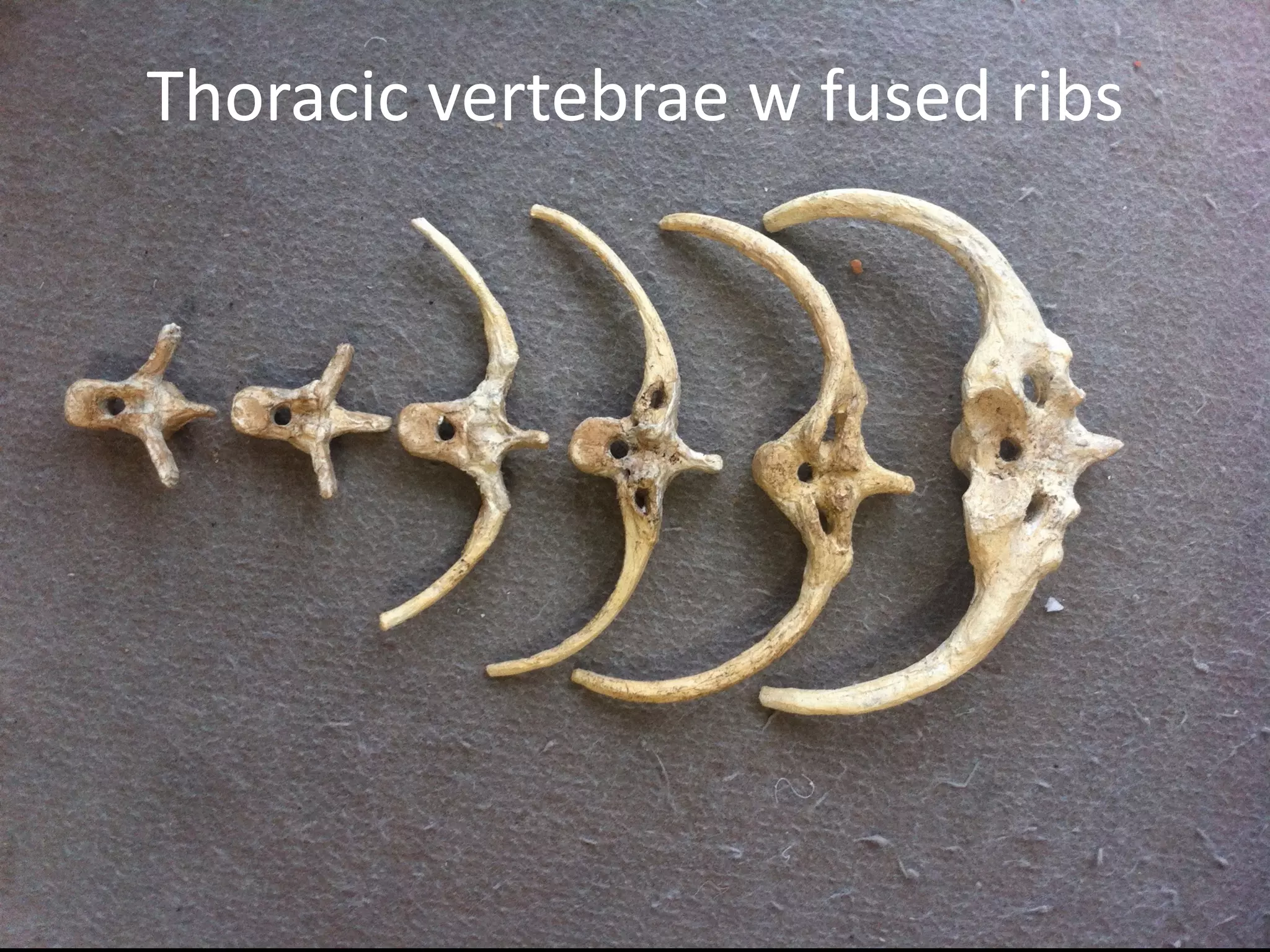 Thoracic	vertebrae	w	fused	ribs
 