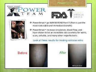  PowerStrips™ go WAY BEYOND Pain!!! (Pain is just the
most noticeable and immediate benefit)
 PowerStrips™ increase circulation, blood flow, and
have shown to be an incredible skin cosmetic for warts,
scars, cellulite, and many other imperfections
Before After
48 hours later
Look at these results for treating varicose veins
™
 
