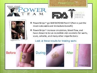 Before AfterDuring
 PowerStrips™ go WAY BEYOND Pain!!! (Pain is just the
most noticeable and immediate benefit)
 PowerStrips™ increase circulation, blood flow, and
have shown to be an incredible skin cosmetic for warts,
scars, cellulite, and many other imperfections
Look at these results for treating warts
10 days later
™
 