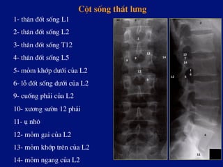 Cét sèng th¾t l­ng
1- th©n ®èt sèng L1
2- th©n ®èt sèng L2
3- th©n ®èt sèng T12
4- th©n ®èt sèng L5
5- mám khíp d­íi cña L2
6- lç ®èt sèng d­íi cña L2
9- cuèng ph¶i cña L2
10- x­¬ng s­ên 12 ph¶i
11- ô nh«
12- mám gai cña L2
13- mám khíp trªn cña L2
14- mám ngang cña L2
 