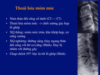 Tho¸i hãa mám mãc
•  N¨m th©n ®èt sèng cæ d­íi (C3 – C7)
•  Tho¸i hãa mám mãc -> chåi x­¬ng g©y hÑp
lç ghÐp
•  XQ th¼ng: mám mãc trßn, khe khíp hÑp, x¬
cøng x­¬ng
•  XQ nghiªng: ®­êng s¸ng ch¹y ngang th©n
®èt sèng víi bê x¬ cøng (H×nh). Hay bÞ
nhÇm víi ®­êng g·y
•  Chôp chÕch 550: béc lé tèt lç ghÐp (H×nh)
 
