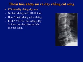 Tho¸i hãa khíp sîi vµ d©y ch»ng cét sèng
•  Cèt hãa d©y ch»ng däc sau
-  N.nh©n kh«ng biÕt. 40-70 tuæi
-  B.n cã hoÆc kh«ng cã tr.chøng
-  C3-C5 / T3-T7: d¶i x­¬ng dµy
1-5mm däc theo bê sau th©n
c¸c ®èt sèng.
 