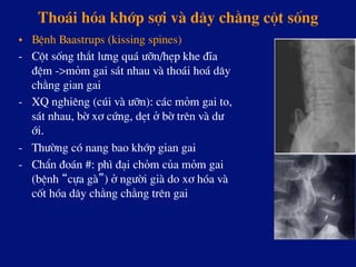 Tho¸i hãa khíp sîi vµ d©y ch»ng cét sèng
•  BÖnh Baastrups (kissing spines)
-  Cét sèng th¾t l­ng qu¸ ­ìn/hÑp khe ®Üa
®Öm ->mám gai s¸t nhau vµ tho¸i ho¸ d©y
ch»ng gian gai
-  XQ nghiªng (cói vµ ­ìn): c¸c mám gai to,
s¸t nhau, bê x¬ cøng, dÑt ë bê trªn vµ d­
íi.
-  Th­êng cã nang bao khíp gian gai
-  ChÈn ®o¸n #: ph× ®¹i chám cña mám gai
(bÖnh “cùa gµ”) ë ng­êi giµ do x¬ hãa vµ
cèt hãa d©y ch»ng ch»ng trªn gai
 