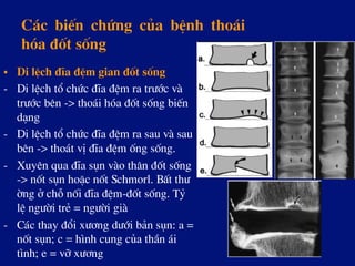 C¸c biÕn chøng cña bÖnh tho¸i
hãa ®èt sèng
•  Di lÖch ®Üa ®Öm gian ®èt sèng
-  Di lÖch tæ chøc ®Üa ®Öm ra tr­íc vµ
tr­íc bªn -> tho¸i hãa ®èt sèng biÕn
d¹ng
-  Di lÖch tæ chøc ®Üa ®Öm ra sau vµ sau
bªn -> tho¸t vÞ ®Üa ®Öm èng sèng.
-  Xuyªn qua ®Üa sôn vµo th©n ®èt sèng
-> nèt sôn hoÆc nèt Schmorl. BÊt th­
êng ë chç nèi ®Üa ®Öm-®èt sèng. Tû
lÖ ng­êi trÎ = ng­êi giµ
-  C¸c thay ®æi x­¬ng d­íi b¶n sôn: a =
nèt sôn; c = h×nh cung cña thÇn ¸i
t×nh; e = vì x­¬ng
 