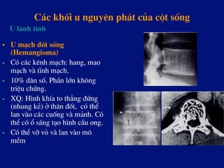 C¸c khèi u nguyªn ph¸t cña cét sèng
•  U m¹ch ®èt sèng
(Hemangioma)
-  Cã c¸c kªnh m¹ch: hang, mao
m¹ch vµ tÜnh m¹ch.
-  10% d©n sè. PhÇn lín kh«ng
triÖu chøng.
-  XQ: H×nh khÝa to th¼ng ®øng
(nhung kÎ) ë th©n ®èt, cã thÓ
lan vµo c¸c cuèng vµ m¶nh. Cã
thÓ cã æ s¸ng t¹o h×nh cÇu ong.
-  Cã thÓ vì vá vµ lan vµo m«
mÒm
U lµnh tÝnh
 
