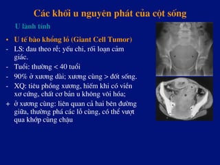 C¸c khèi u nguyªn ph¸t cña cét sèng
•  U tÕ bµo khæng lå (Giant Cell Tumor)
-  LS: ®au theo rÔ; yÕu chi, rèi lo¹n c¶m
gi¸c.
-  Tuæi: th­êng < 40 tuæi
-  90% ë x­¬ng dµi; x­¬ng cïng > ®èt sèng.
-  XQ: tiªu phång x­¬ng, hiÕm khi cã viÒn
x¬ cøng, chÊt c¬ b¶n u kh«ng v«i hãa;
+ ë x­¬ng cïng: liªn quan c¶ hai bªn ®­êng
gi÷a, th­êng ph¸ c¸c lç cïng, cã thÓ v­ît
qua khíp cïng chËu
U lµnh tÝnh
 