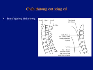 ChÊn th­¬ng cét sèng cæ
•  T­ thÕ nghiªng b×nh th­êng
 