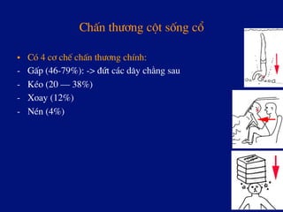 ChÊn th­¬ng cét sèng cæ
•  Cã 4 c¬ chÕ chÊn th­¬ng chÝnh:
-  GÊp (46-79%): -> ®øt c¸c d©y ch»ng sau
-  KÐo (20 – 38%)
-  Xoay (12%)
-  NÐn (4%)
 