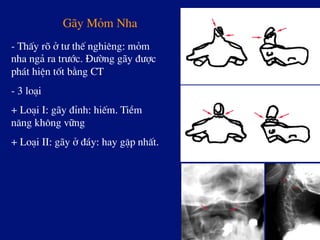 G·y Mám Nha
- ThÊy râ ë t­ thÕ nghiªng: mám
nha ng¶ ra tr­íc. §­êng g·y ®­îc
ph¸t hiÖn tèt b»ng CT
- 3 lo¹i
+ Lo¹i I: g·y ®Ønh: hiÕm. TiÒm
n¨ng kh«ng v÷ng
+ Lo¹i II: g·y ë ®¸y: hay gÆp nhÊt.
 