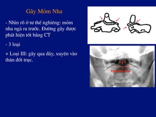G·y Mám Nha
- Nh×n râ ë t­ thÕ nghiªng: mám
nha ng¶ ra tr­íc. §­êng g·y ®­îc
ph¸t hiÖn tèt b»ng CT
- 3 lo¹i
+ Lo¹i III: g·y qua ®¸y, xuyªn vµo
th©n ®èt trôc.
 