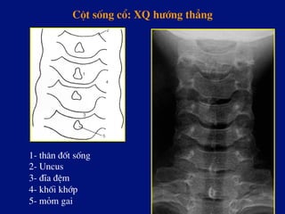 Cét sèng cæ: XQ h­íng th¼ng
1- th©n ®èt sèng
2- Uncus
3- ®Üa ®Öm
4- khèi khíp
5- mám gai
 