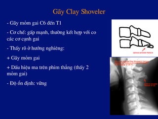 G·y Clay Shoveler
- G·y mám gai C6 ®Õn T1
- C¬ chÕ: gÊp m¹nh, th­êng kÕt hîp víi co
c¸c c¬ c¹nh gai
- ThÊy râ ë h­íng nghiªng:
+ G·y mám gai
+ DÊu hiÖu ma trªn phim th¼ng (thÊy 2
mám gai)
- §é æn ®Þnh: v÷ng
 