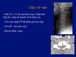 G·y vì vôn
- G·y C3 - C7 do nÐn theo trôc. ChÊn th­
¬ng tñy sèng do m¶nh vì di lÖch sau.
- Yªu cÇu chôp CT ®Ó ®¸nh gi¸ lan réng
- C¬ chÕ: nÐn theo trôc
- §é æn ®Þnh: v÷ng
 