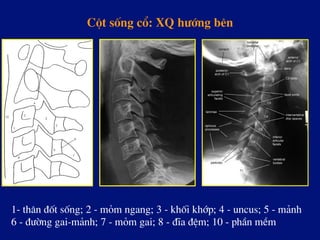 Cét sèng cæ: XQ h­íng bªn
1- th©n ®èt sèng; 2 - mám ngang; 3 - khèi khíp; 4 - uncus; 5 - m¶nh
6 - ®­êng gai-m¶nh; 7 - mám gai; 8 - ®Üa ®Öm; 10 - phÇn mÒm
 