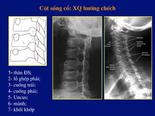 Cét sèng cæ: XQ h­íng chÕch
1- th©n §S;
2- lç ghÐp ph¶i;
3- cuèng tr¸i;
4- cuèng ph¶i;
5- Uncus;
6- m¶nh;
7- khèi khíp
 