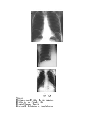 Tắc ruột
Phân loại:
Theo nguyên nhân: Do bít tắc – Do mạch mạch máu
Theo diễn tiến : cấp – Bán cấp – Mãn
Theo vị trí :Ruột non - Ruột giá
Theo tính chất : tắc hoàn toàn hay không hoàn toàn
 