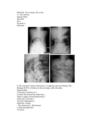 Phân biệt : tắc cơ năng # tắc cơ học
A / Tắc ruột non
Nguyên nhân :
Dày dính
Do u
Do thoát vị
Hình ảnh :
b/ Tắc ruột già ( Colonic obstruction ) : ít gặp hơn ruột non khoảng 5 lần
Khoảng 20-25% ở Zichma so tắc nói chung , diễn tiến chậm
Nguyên nhân :
U tân sinh ( Lành hay ác )
Co thắt ( Do túi thừa hay thiếu máu )
Thoát vị nghẹt ( Incarcerated hernia )
Xoắn ruột ( Volvulus )
Táo bón ( Obstipation )
Hình ảnh : Chung
- Tắc zichma do u : Bơm baryet
c/ Hình ảnh phân biệt :
Vị trí hơi :
 