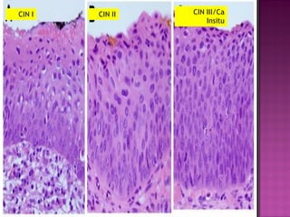 CIN I CIN II CIN III/Ca
Insitu
 