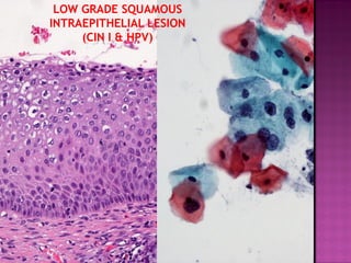 LOW GRADE SQUAMOUS
INTRAEPITHELIAL LESION
(CIN I & HPV)
 