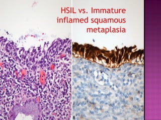 HSIL vs. Immature
inflamed squamous
metaplasia
 