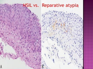 HSIL vs. Reparative atypia
 
