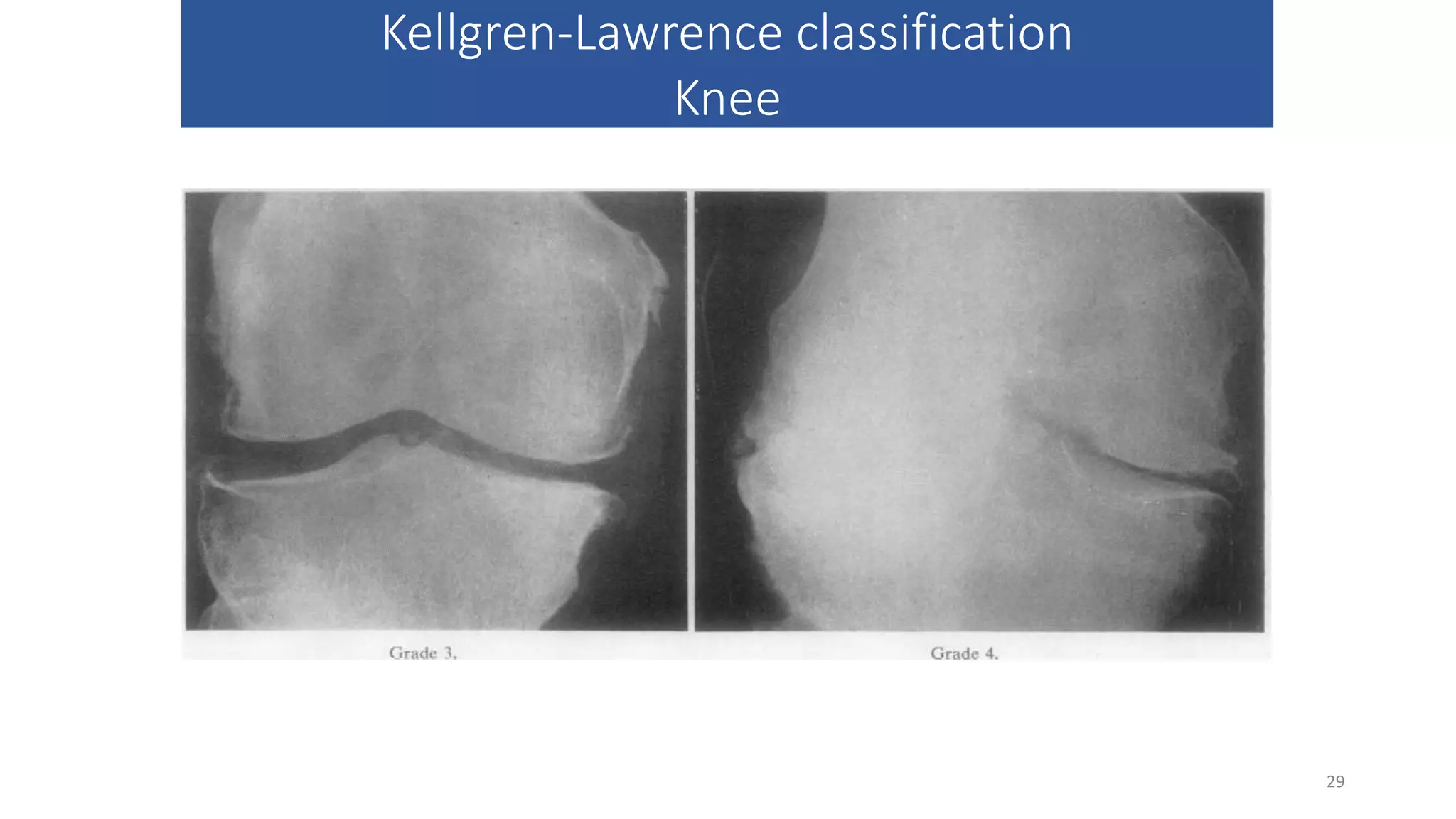 Callawrence Classification X QUANG KHỚP GỐI.pptx