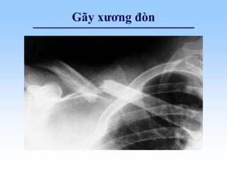 Gãy xương đòn
 