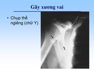 Gãy xương vai
• Chụp thế
ngiêng (chữ Y)
 