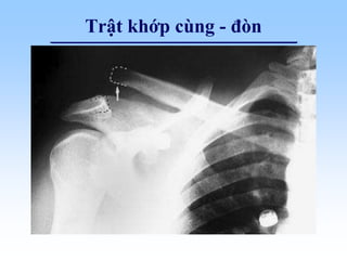 Trật khớp cùng - đòn
 