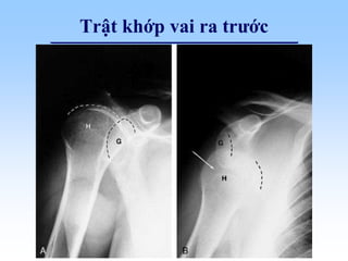 Trật khớp vai ra trước
 
