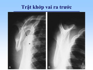 Trật khớp vai ra trước
 
