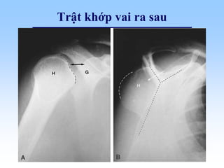 Trật khớp vai ra sau
 