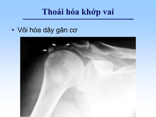 Thoái hóa khớp vai
• Vôi hóa dây gân cơ
 