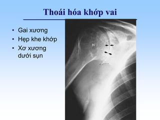 Thoái hóa khớp vai
• Gai xương
• Hẹp khe khớp
• Xơ xương
dưới sụn
 