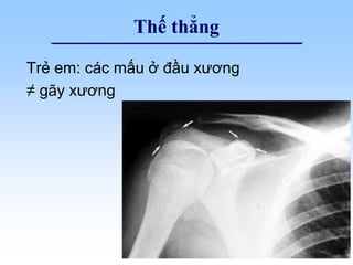 Thế thẳng
Trẻ em: các mấu ở đầu xương
≠ gãy xương
 