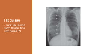 Hít đủsâu
-
‐Cung sau xương
sườn 10 nằm trên
vòm hoành (P)
 