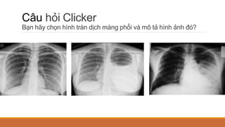 Câu hỏi Clicker
Bạn hãy chọn hình tràn dịch màng phổi và mô tả hình ảnh đó?
 