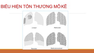 BIỂU HIỆN TỔN THƯƠNG MÔKẼ
 