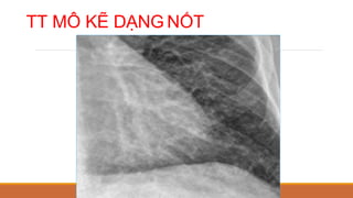 TT MÔ KẼ DẠNG NỐT
 